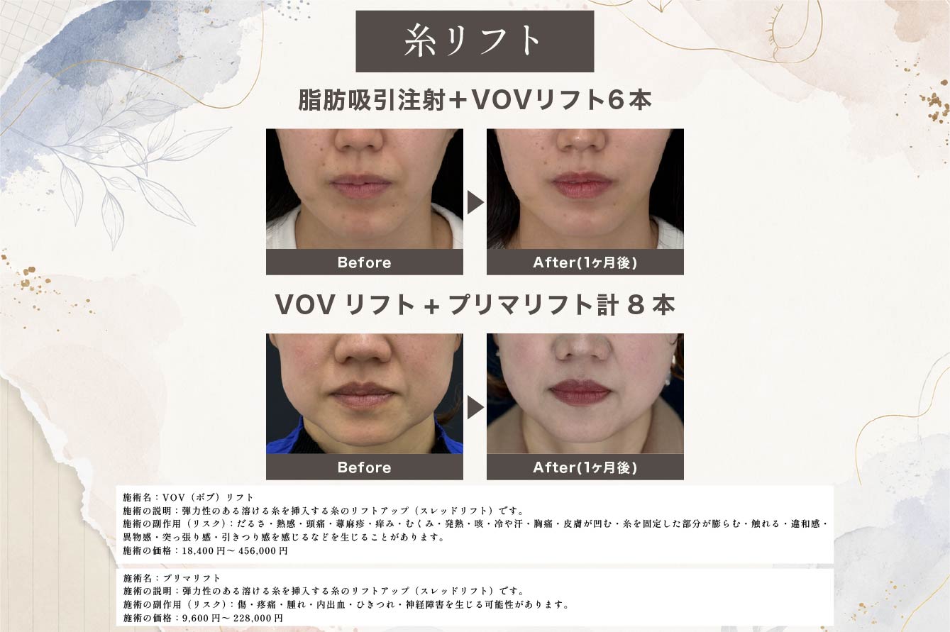 糸リフト