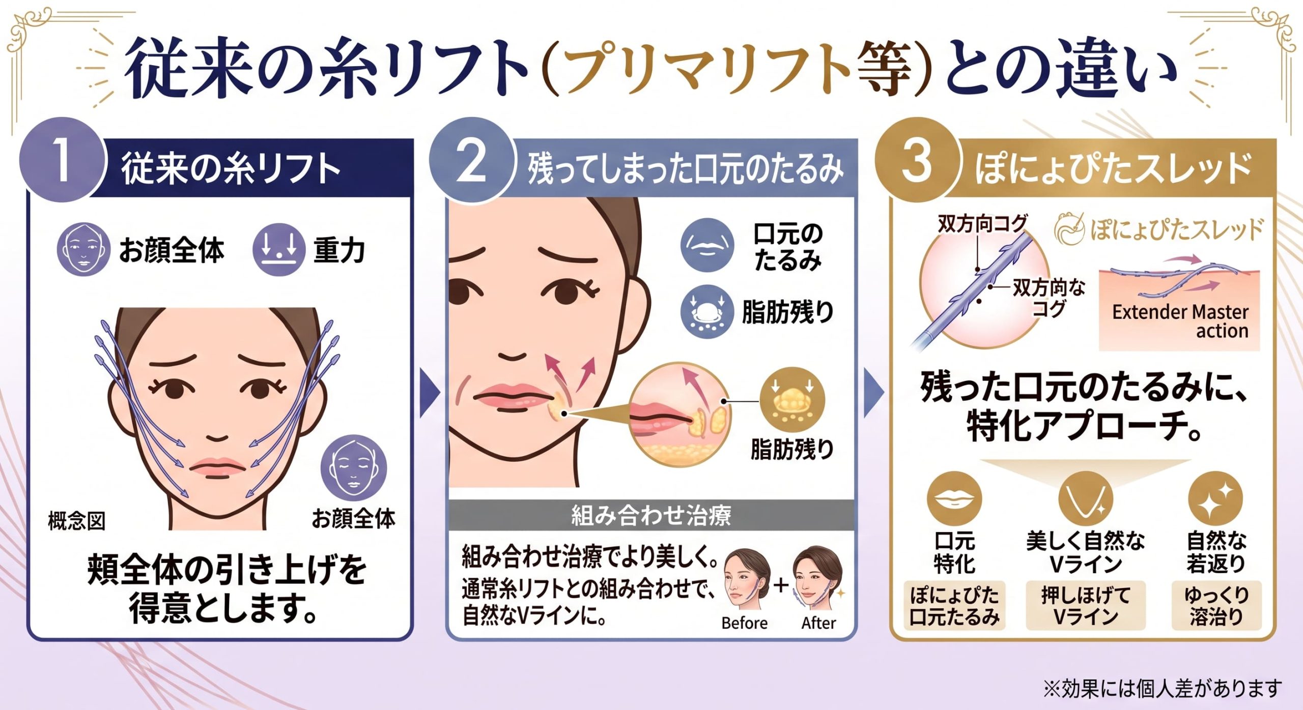 従来の糸リフト（プリマリフト等）との違い