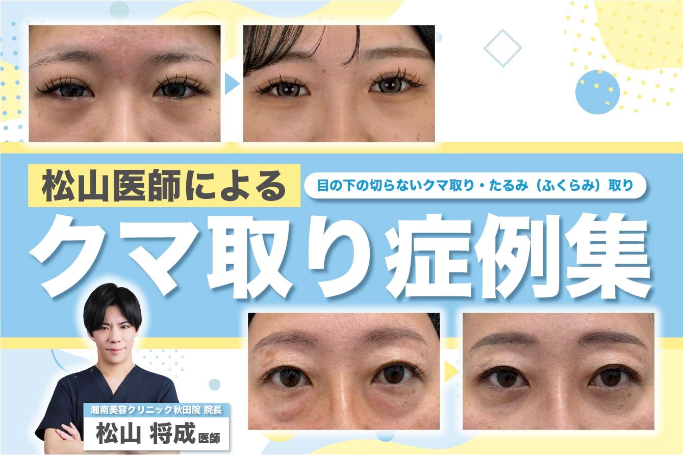 【目の下の切らないクマ取り】”疲れ顔”解消!SBC秋田院のクマ取り症例集