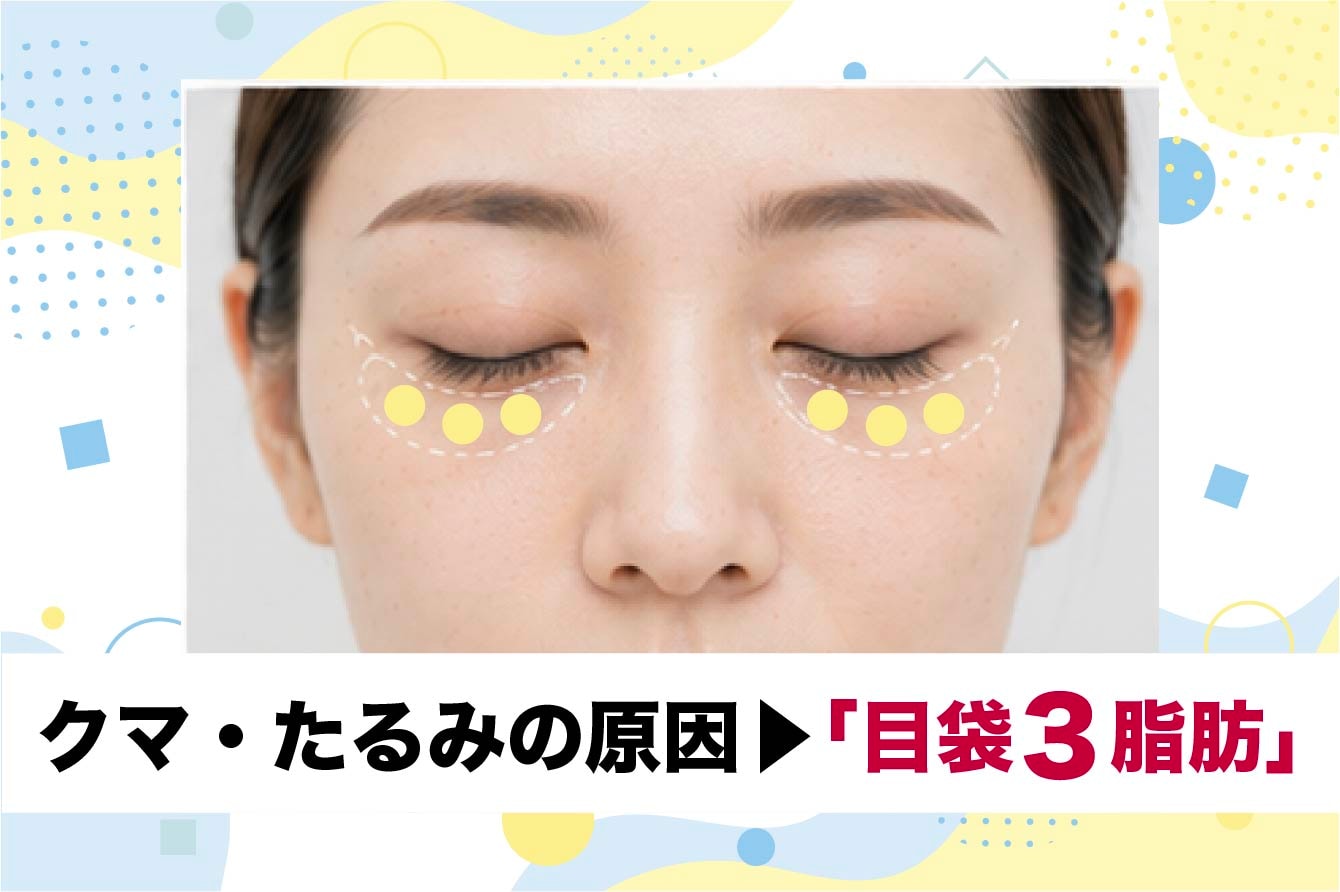 切らないクマ取りのメカニズムと「目袋3脂肪」へのアプローチ