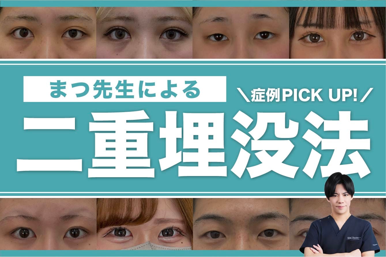 【秋田】二重整形は松山医師へ!初めてでも安心の埋没法症例集