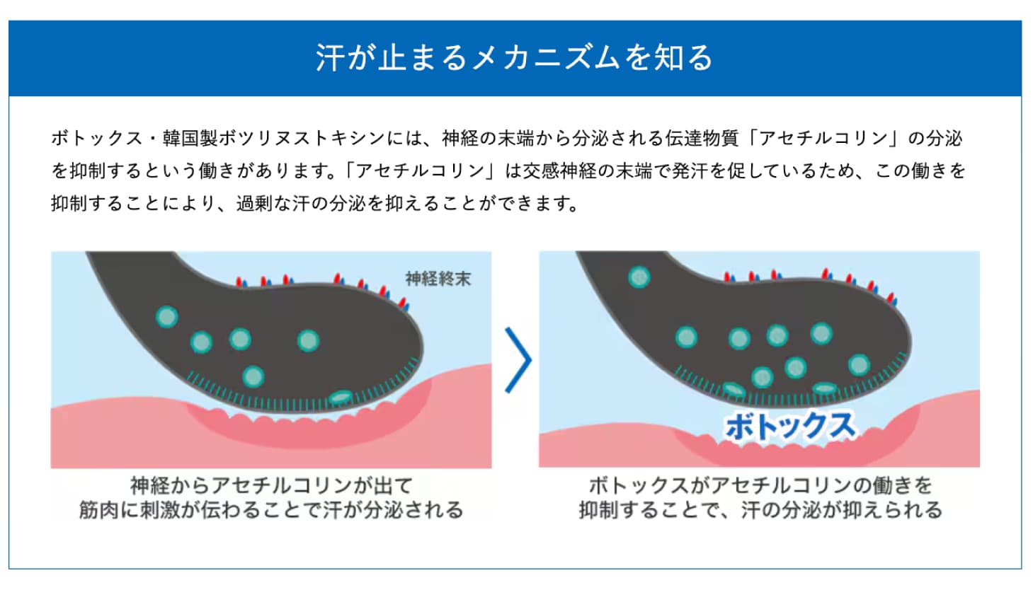注射で汗とニオイを抑える簡単治療