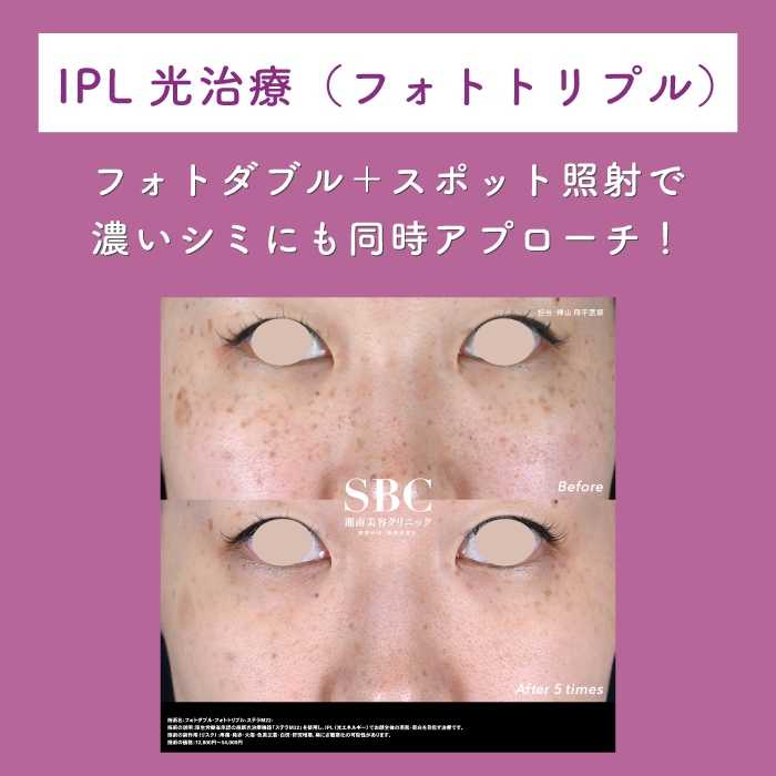 フォトトリプル