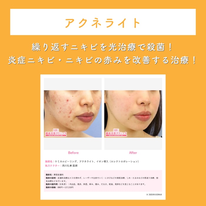 アクネライト