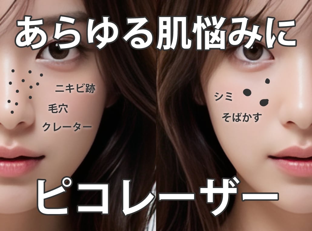 【青森で叶える美肌】湘南美容クリニック青森院の「ピコレーザー」徹底解説！シミ・肝斑・毛穴の悩みを解決！