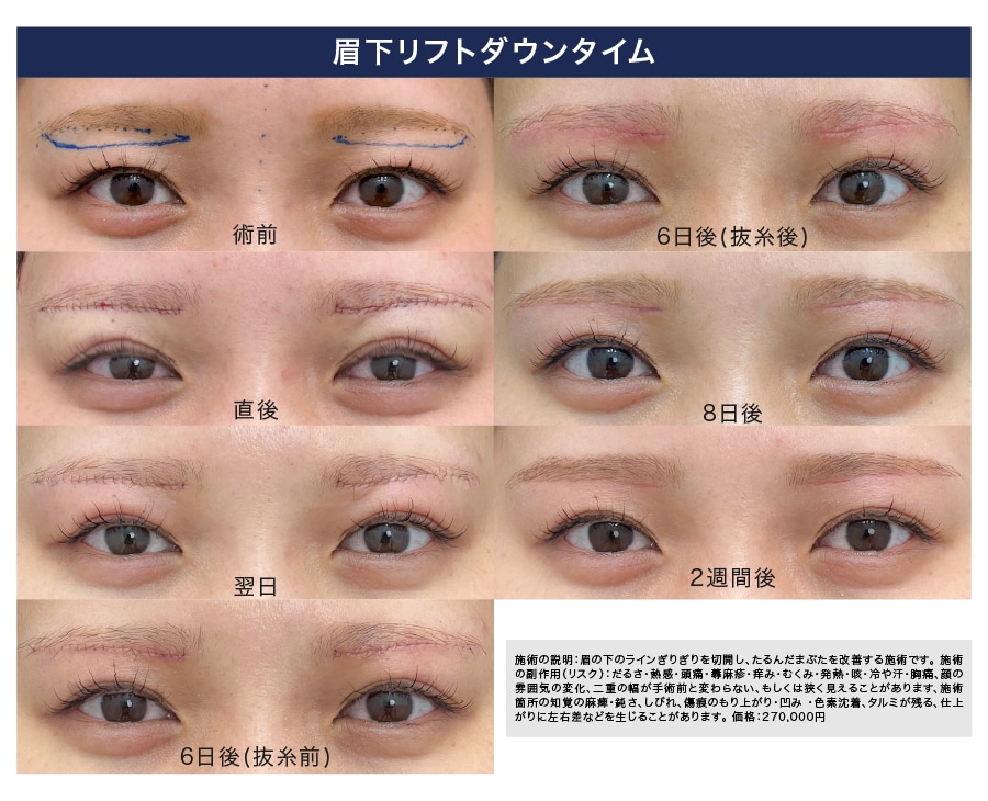 眉下リフトダウンタイム