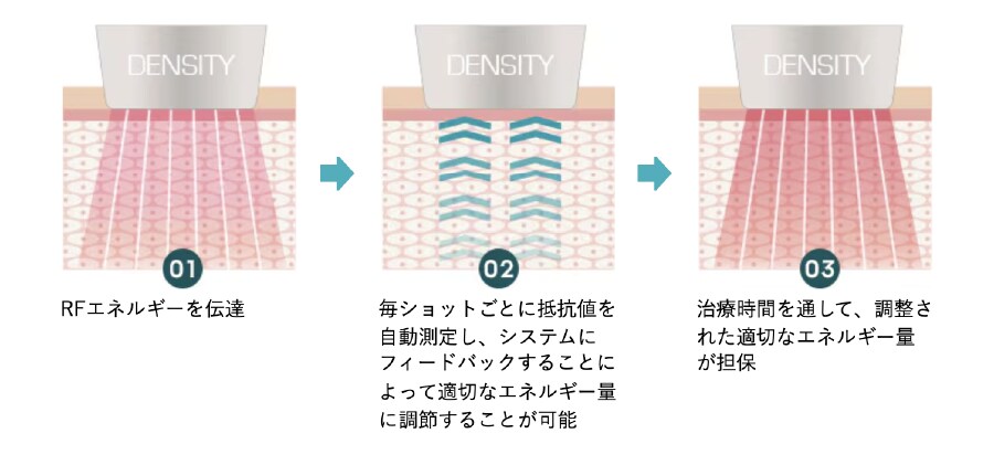 ③肌の状態似合わせて均一なエネルギーで照射
