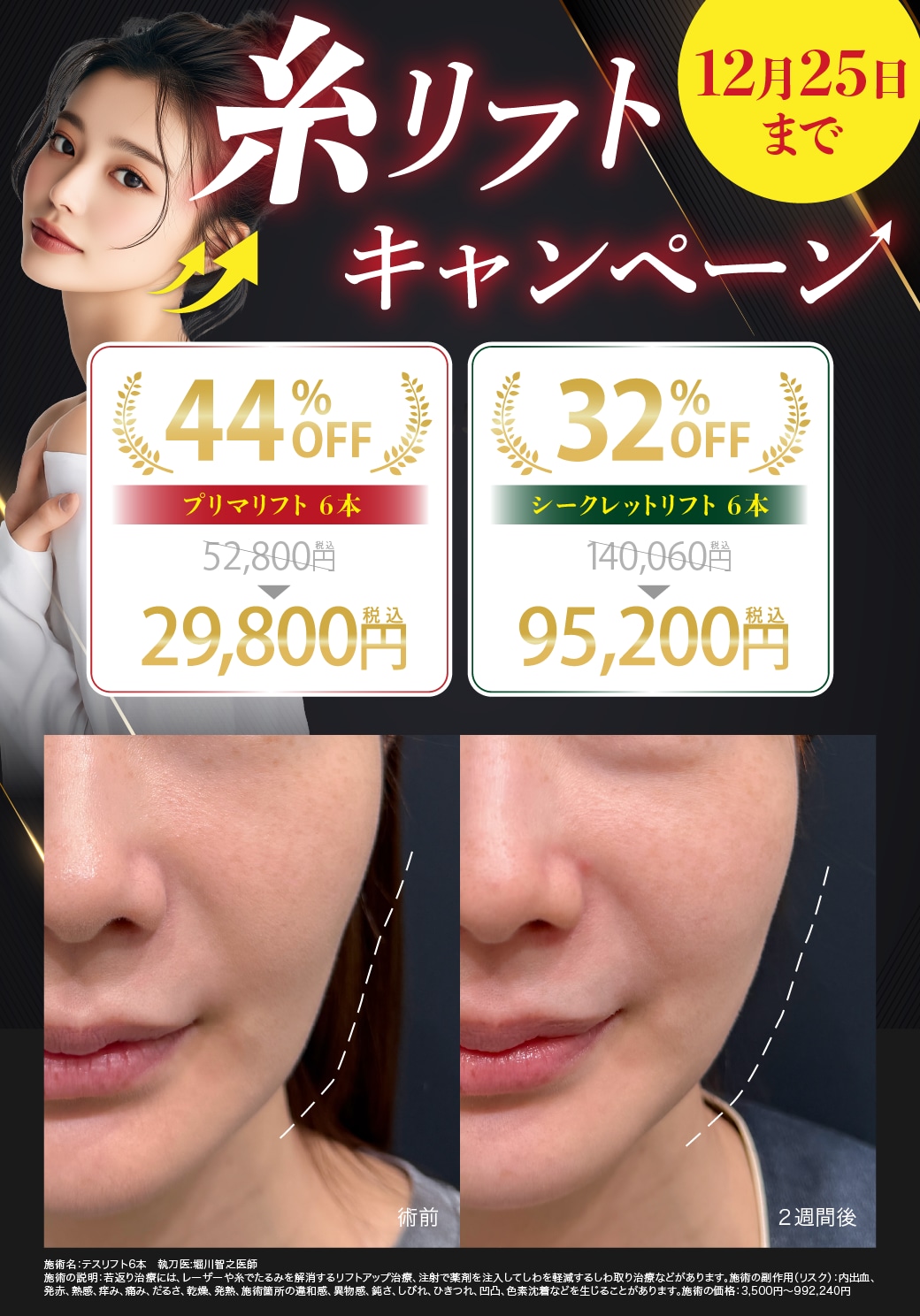 糸リフトキャンペーン