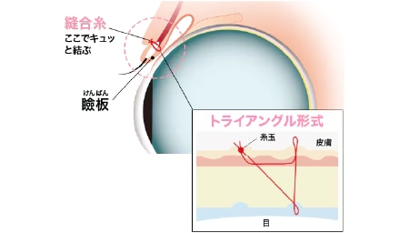 お休みが取れない方に向けた二重埋没法