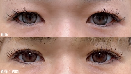 週末二重(両目2点)＋自然癒着法