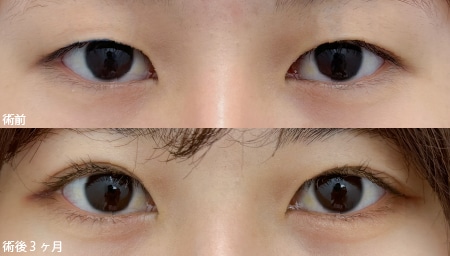 週末二重(両目3点)＋自然癒着法