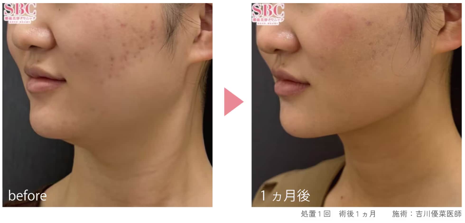 【術後 1ヶ月】 処置1回