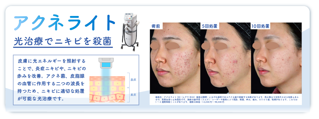 アクネライト：光治療でニキビを殺菌