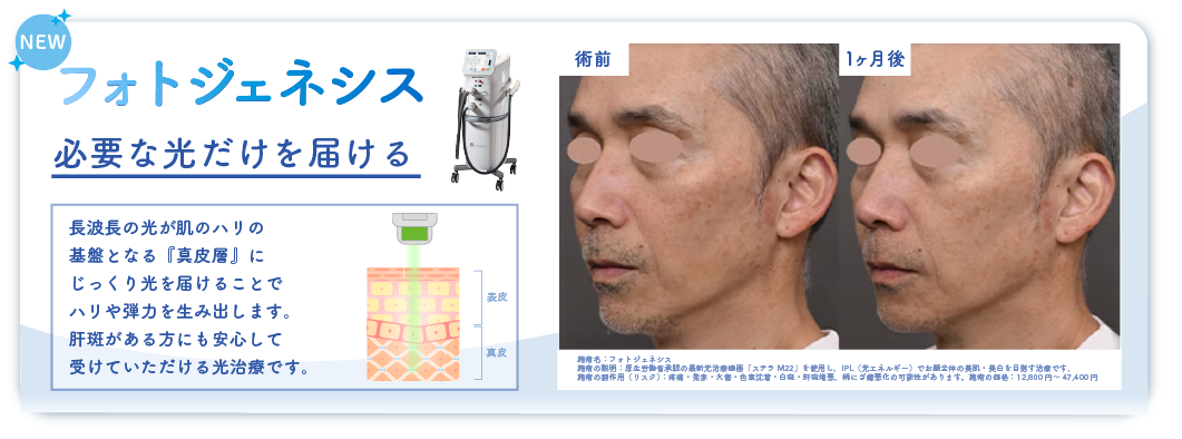 🆕フォトジェネシス：赤ら顔・ニキビ跡・肌の質感改善に特化