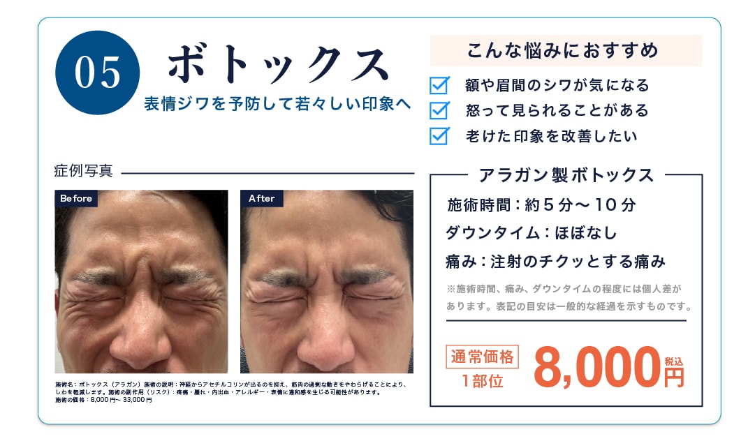 ボトックス