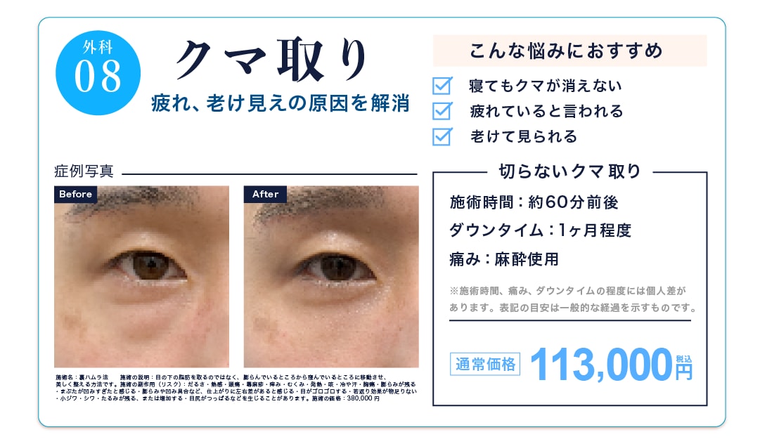 クマ取り