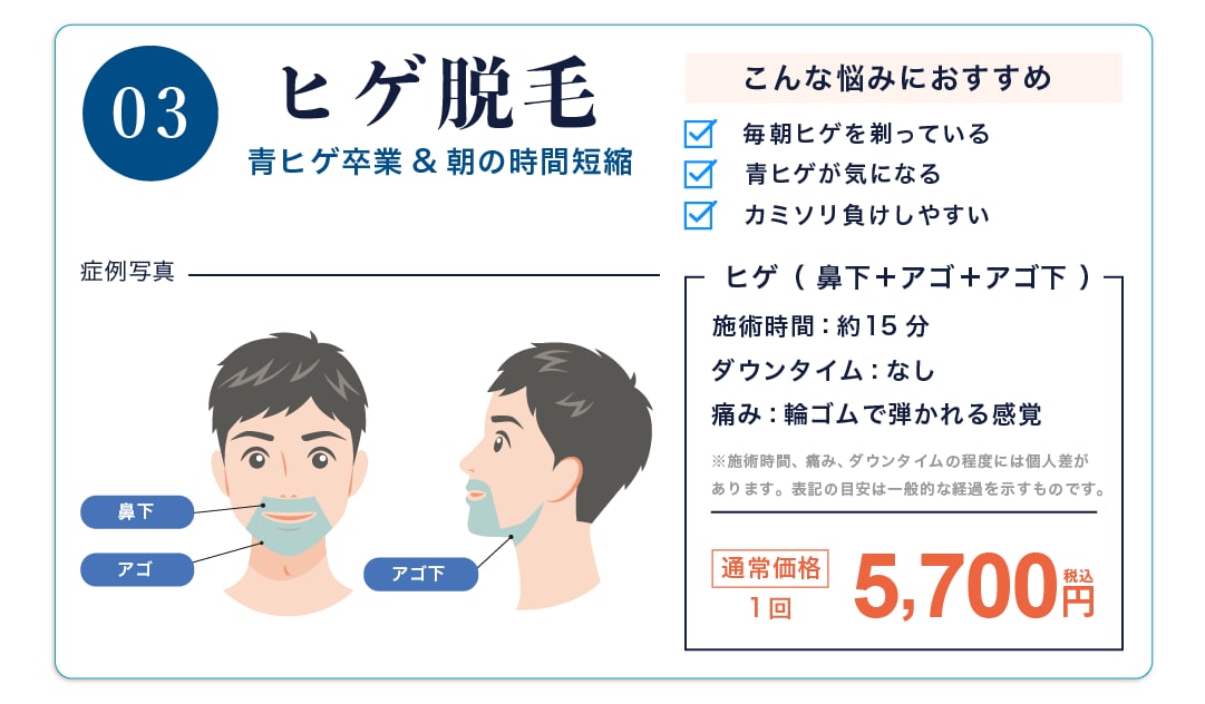 ヒゲ脱毛