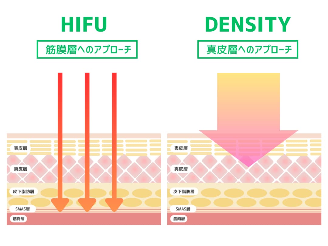POINT1:超音波と高周波の違い