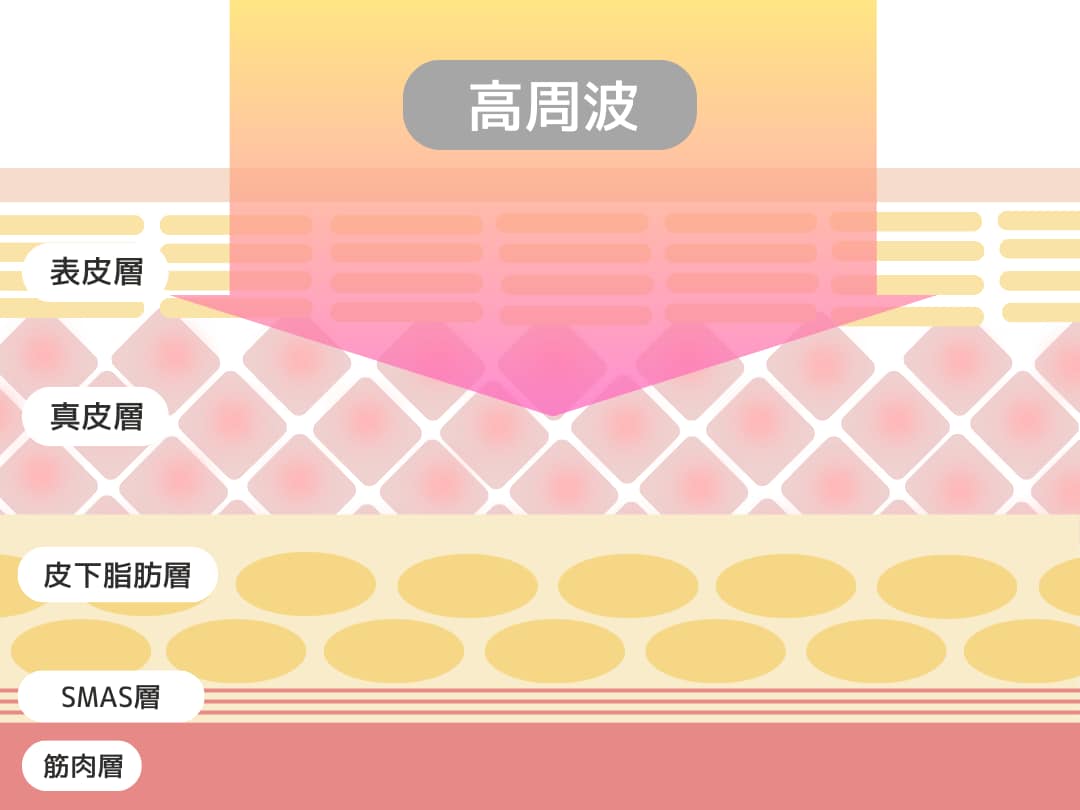 RF（高周波）＝ラジオ波