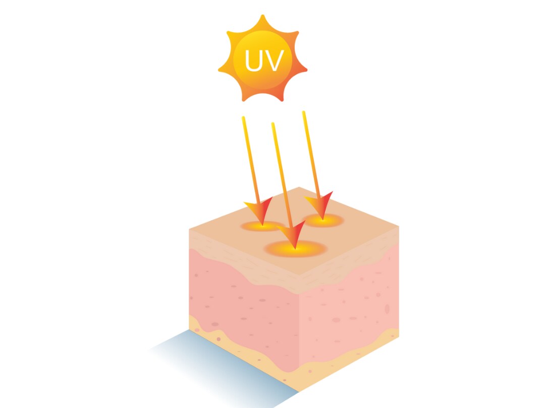 【私のシミ、どの治療がいい？】