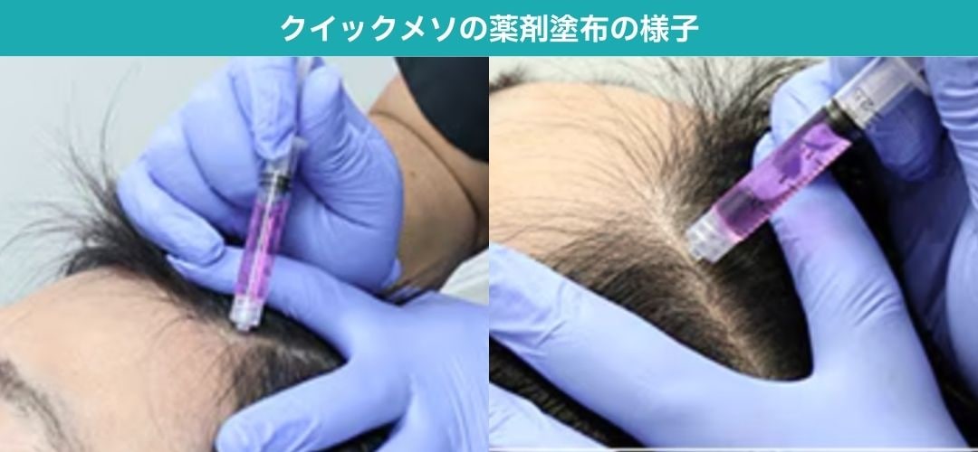 クイックメソ治療