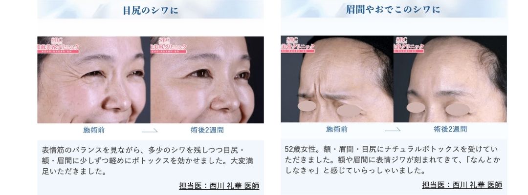 目尻ボトックス・眉間ボトックス