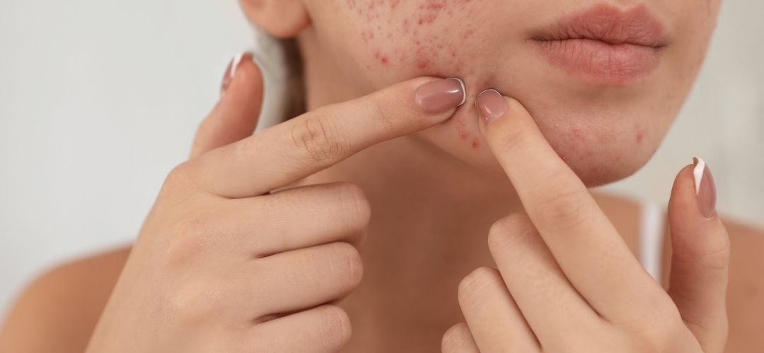 ❹ニキビ予防・くすみ改善