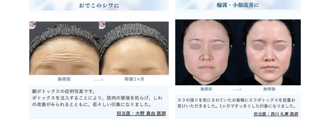 額ボトックス・エラボトックス