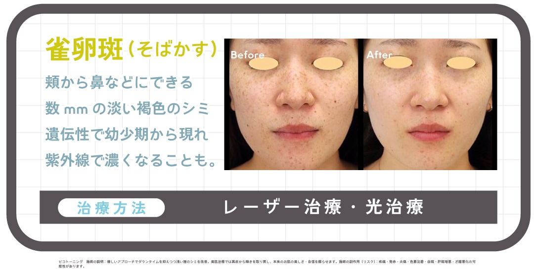 ②【雀卵斑＝そばかす】