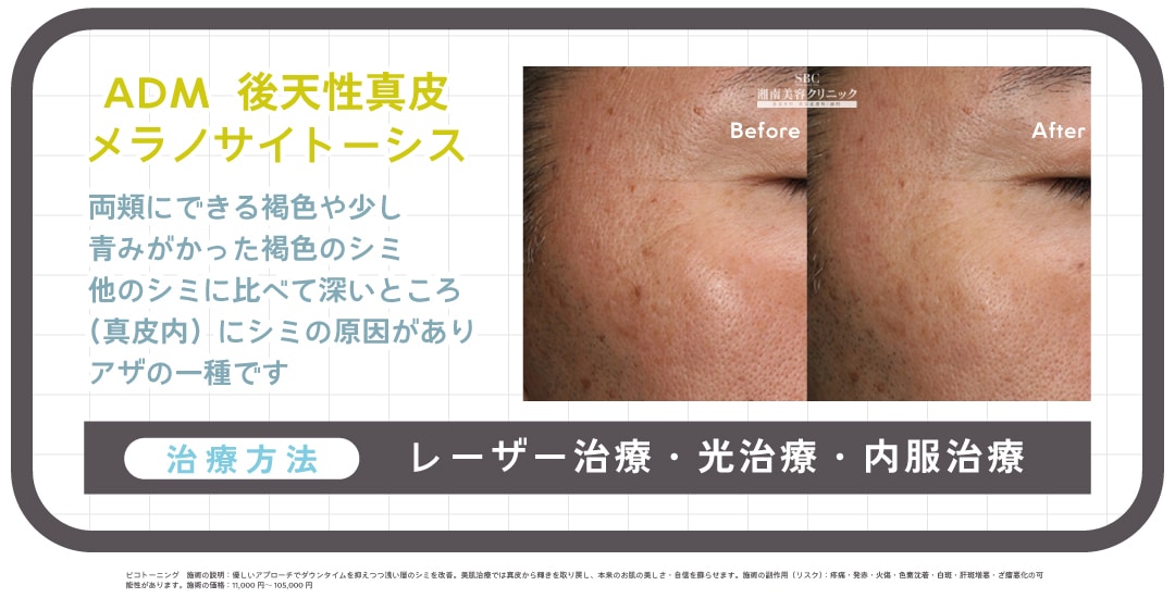 ④【ADM＝後天性真皮メラノサイトーシス 】