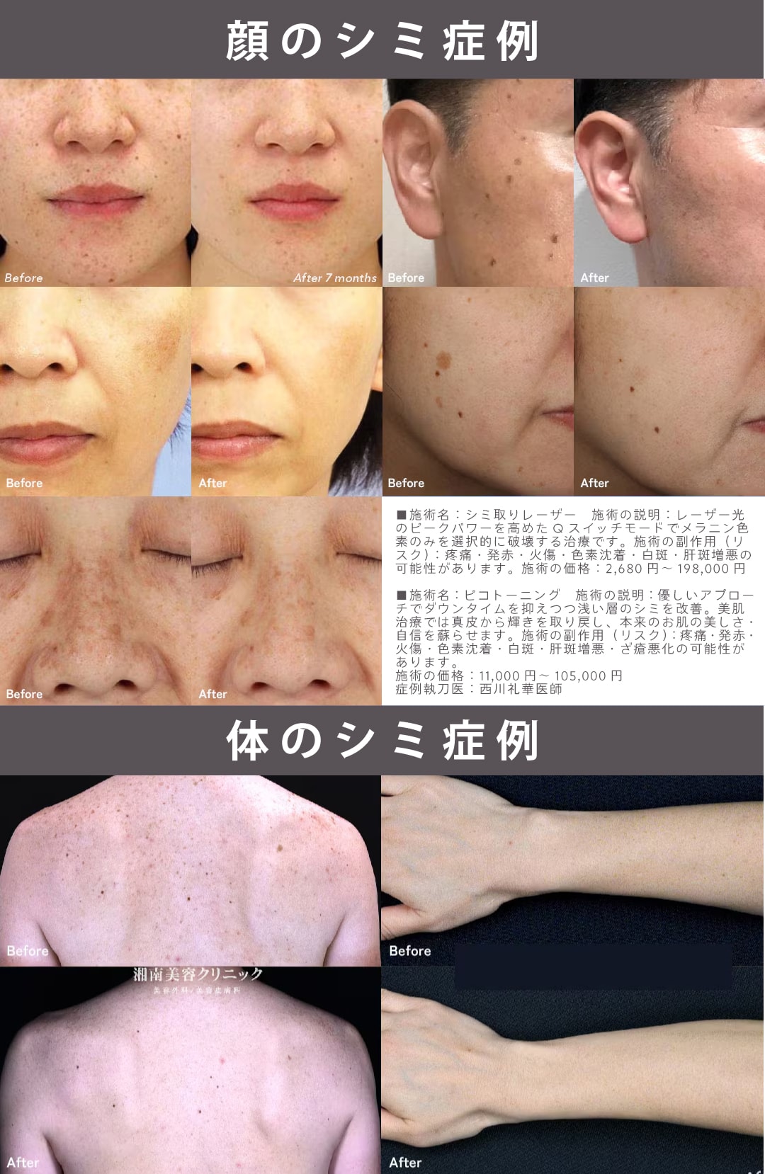 湘南美容クリニックのシミ取り