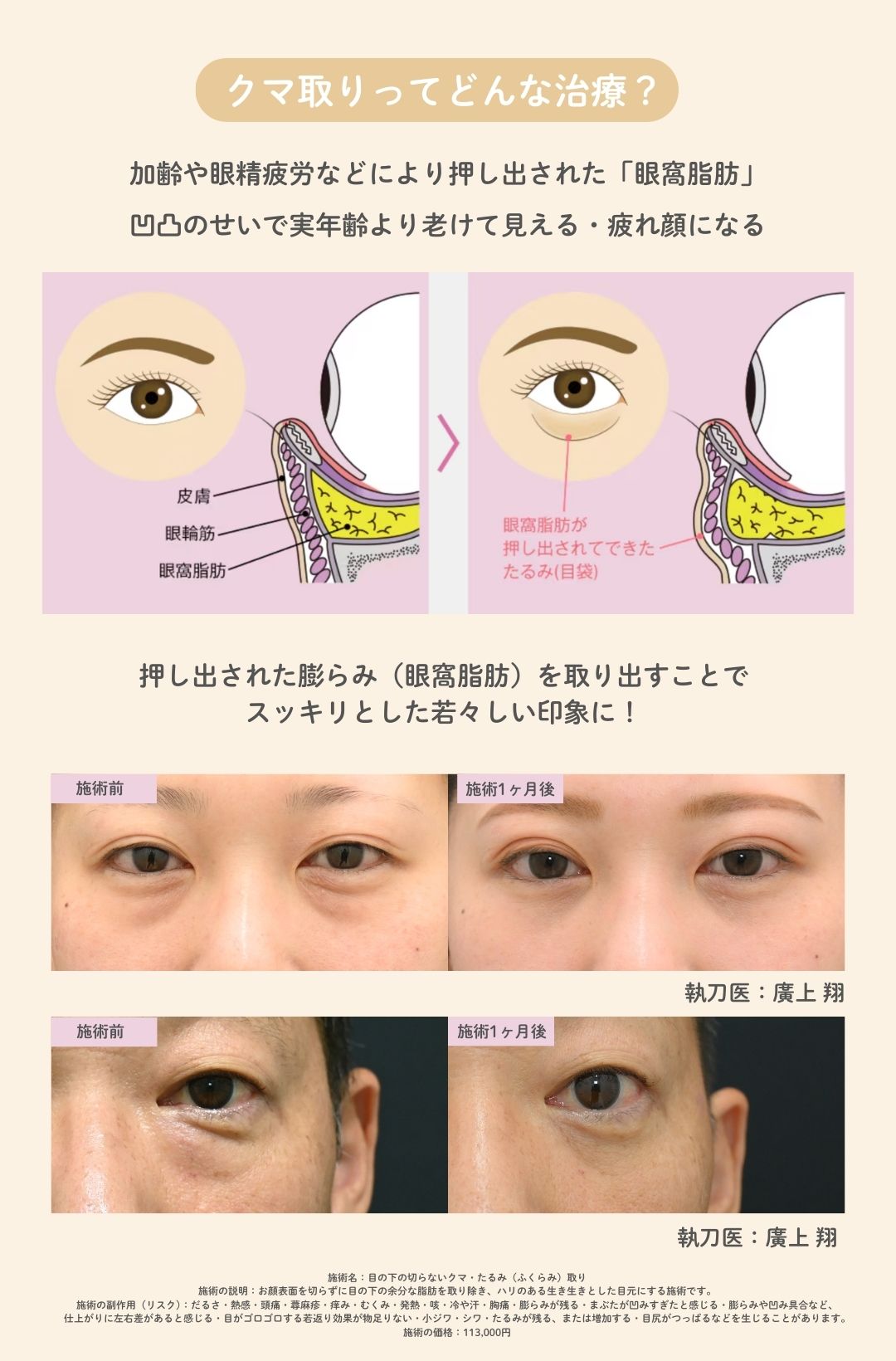 クマ取りってどんな治療？