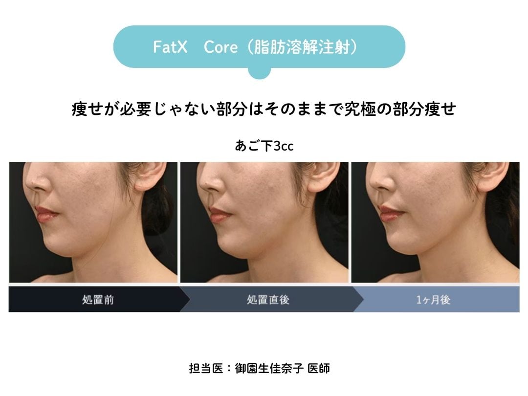 手術なしダウンタイムもほぼなしで部分痩せ