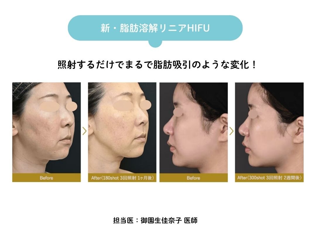 超音波テクノロジーを利用した脂肪溶解できる医療ハイフ