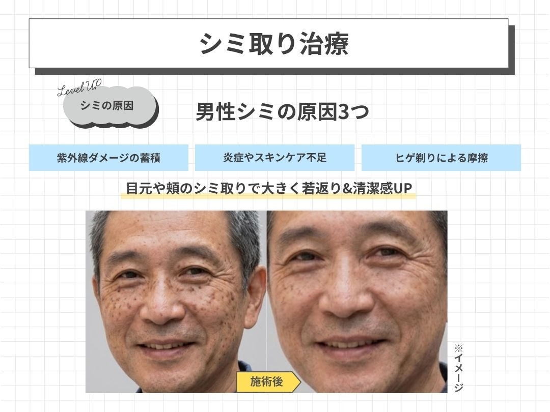 男性のシミは手強いものが多い？！