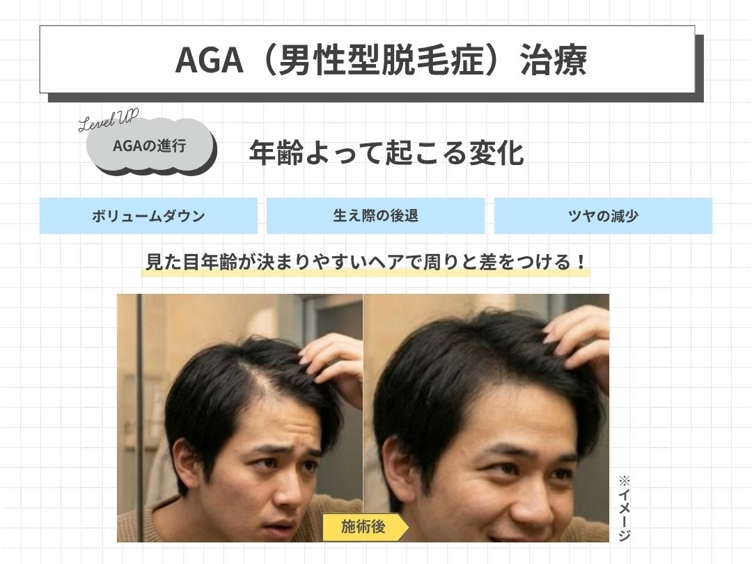 AGAは遺伝、賢い人は20代から治療してます。