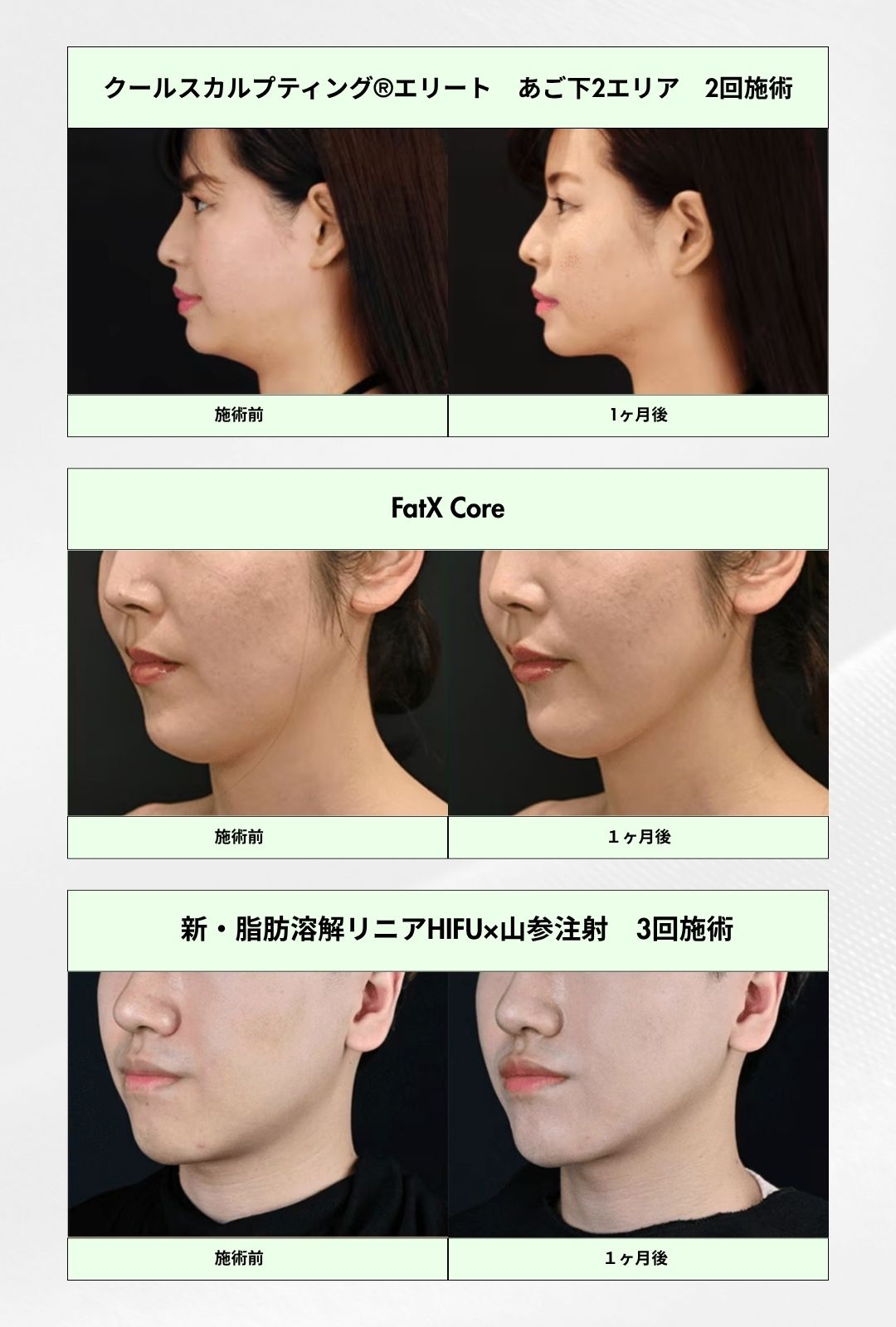脂肪減少治療の症例紹介