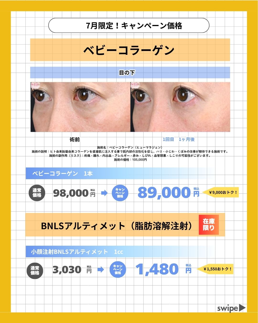 目の下のクマや細かいシワ改善に💉
