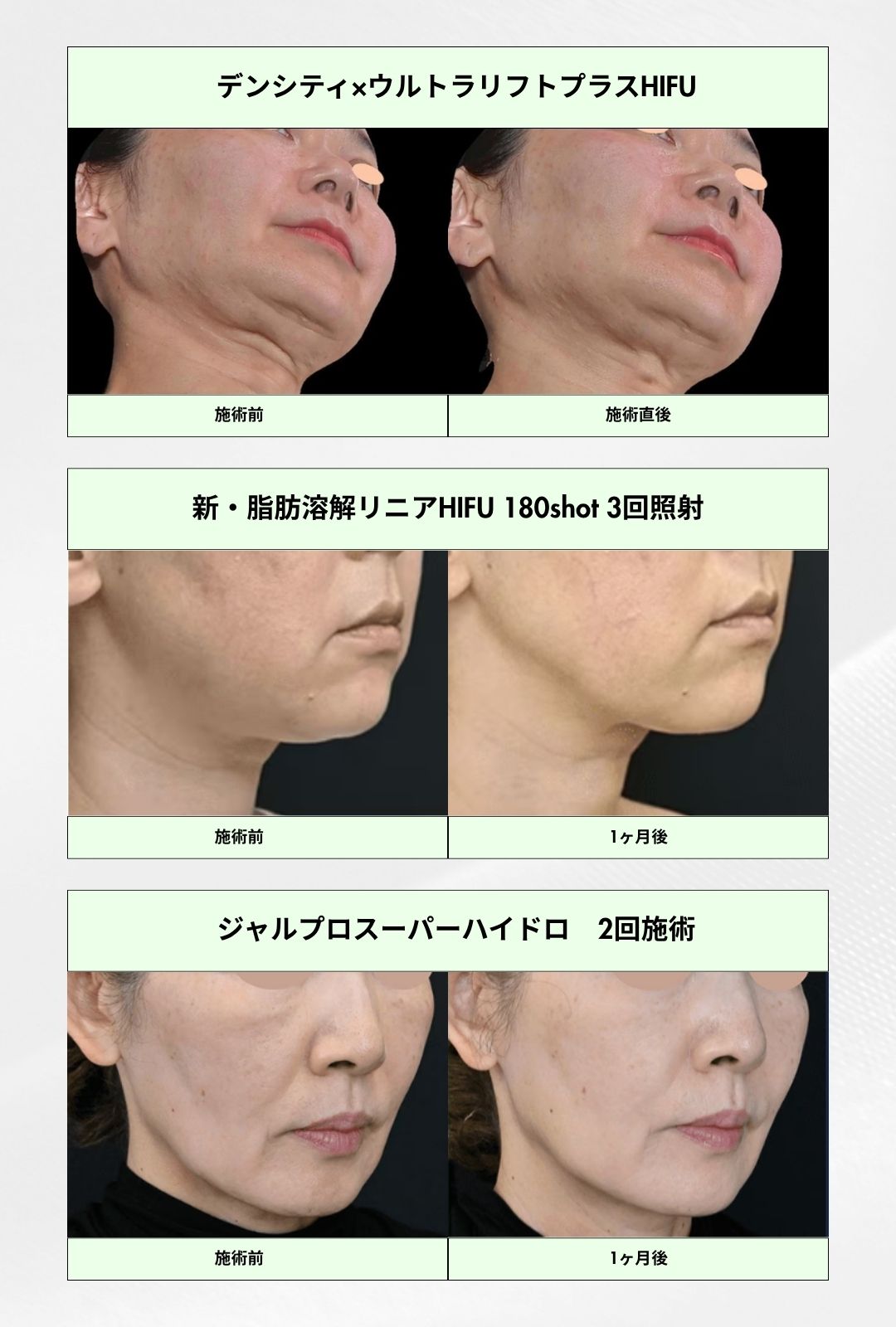 たるみ治療の症例紹介