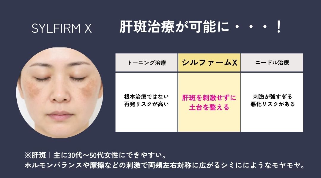 肝斑の根本治療が可能に✨