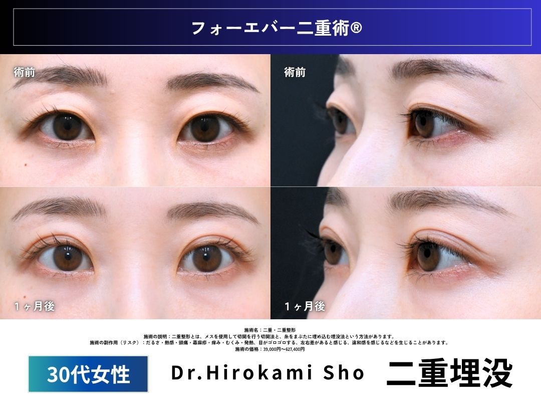 Case3：30代女性　二重埋没症例<br />
