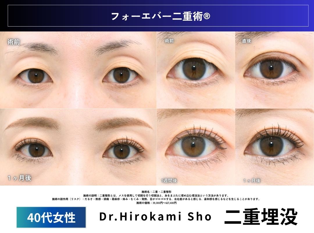 Case4：40代女性　二重埋没症例<br />
