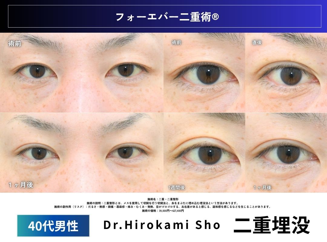 Case5：40代男性　二重埋没症例