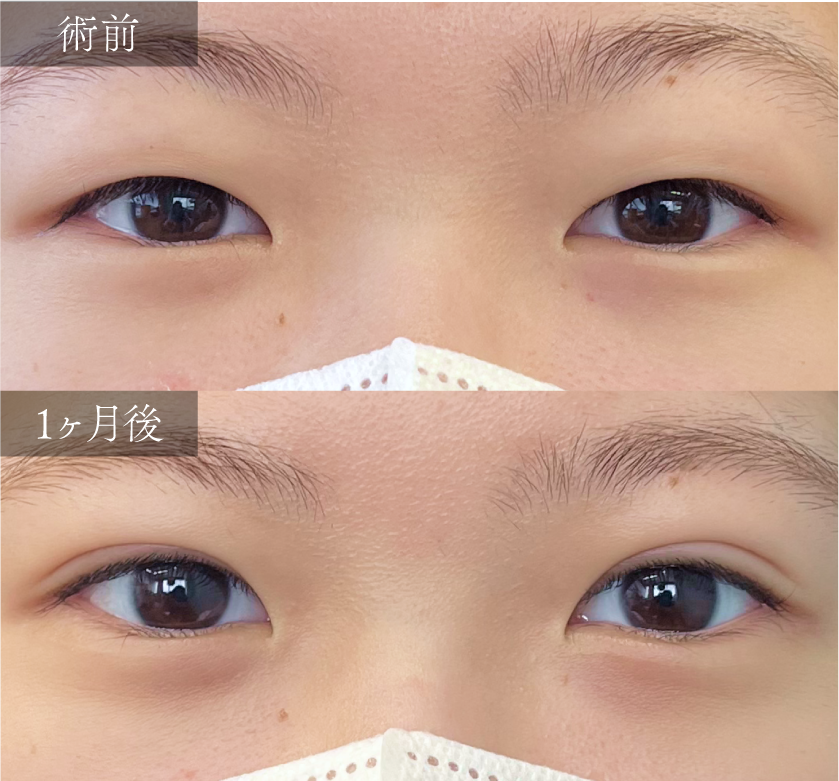 C.【二重埋没+自然癒着セット】~より取れにくく、自然な食い込みの美しい二重ラインへ~