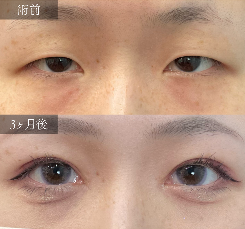 B.【二重埋没+目尻切開】~目の横幅を広げ、優しい印象の大きな目元へ~
