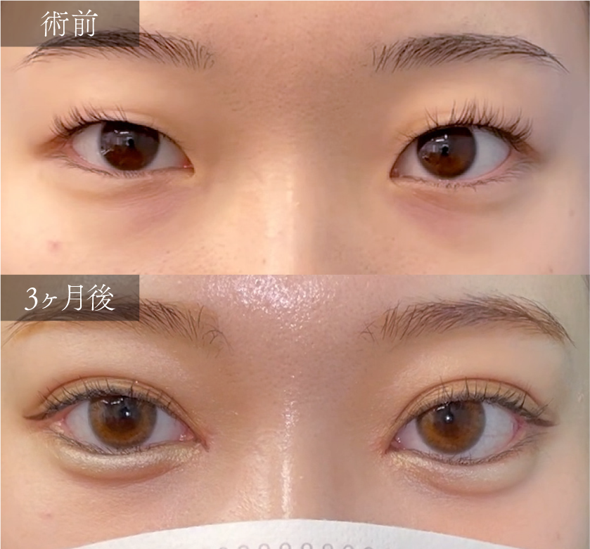 【目元フル整形】~理想のすべてを凝縮!究極のオーダーメイドEYEへ~