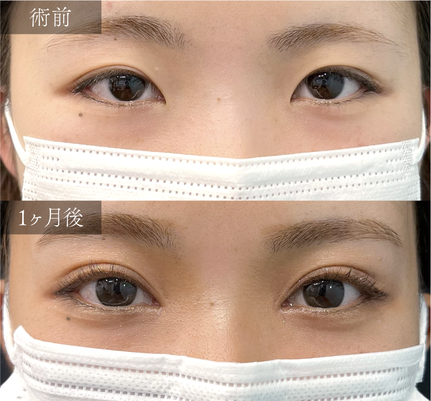 A.【二重埋没＋目頭切開】～蒙古襞を解消し、くっきり平行型二重へ～