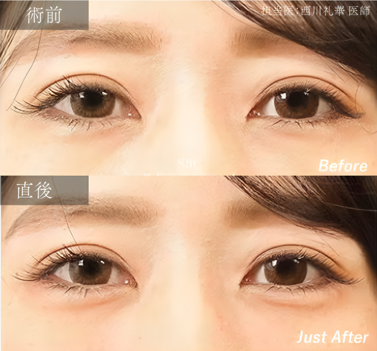 E.【二重埋没＋涙袋ヒアルロン酸】～うるツヤEYEで、愛らしさMAXの魅力的な目元へ～