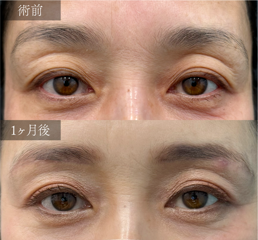 D.【二重埋没+眉下リフト】~まぶたのたるみを改善し、若々しい二重ラインへ~