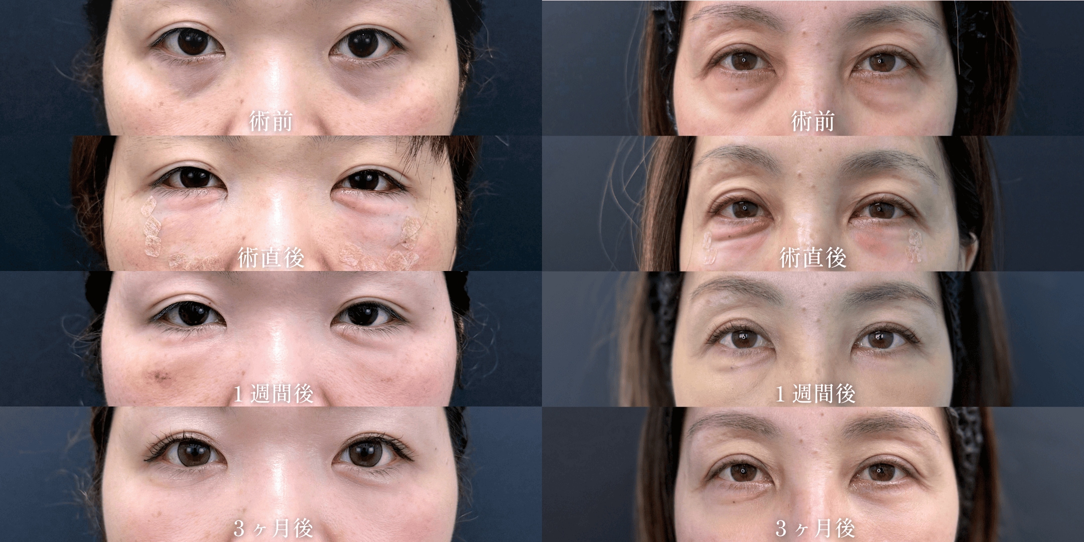 ダウンタイムはどれくらいですか？